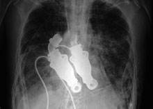X-ray view of dual turbine-like blood pumps implanted to replace explanted heart.