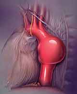 Aortic aneurysm