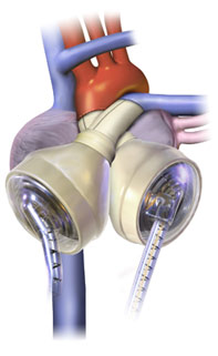 SynCardia temporary Total Artificial Heart (TAH) SynCardia temporary Total Artificial Heart (TAH)