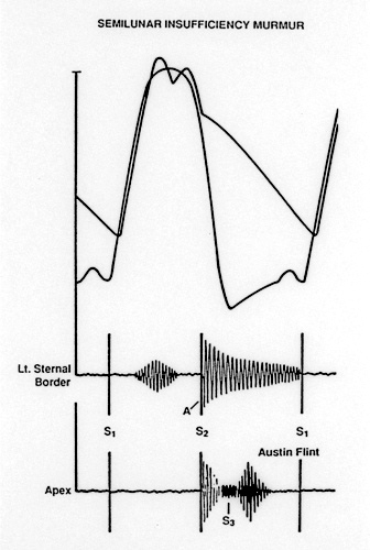 Aortic Regurgitation Aortic Regurgitation