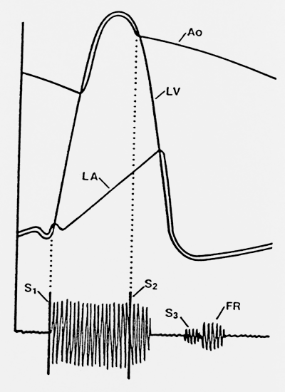 Diagram for Mitral Regurgitation Diagram for Mitral Regurgitation