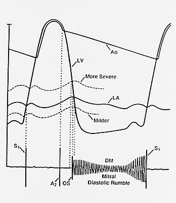 Diagram of opening snap of mitral valve stenosis Diagram of opening snap of mitral valve stenosis