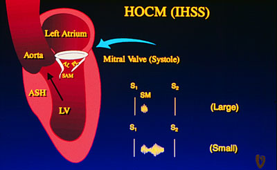 Diagram of auscultation of HOCM Diagram of auscultation of HOCM