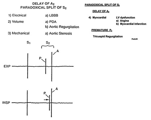 Paradoxical splitting of the second sound. Paradoxical splitting of the second sound.