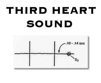 Diagram of third heart sound (S3). Diagram of third heart sound (S3).