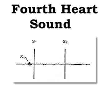 Fourth Heart Sound Fourth Heart Sound
