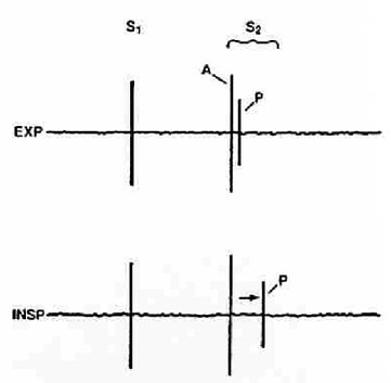 Physiologic Split S2 Physiologic Split S2