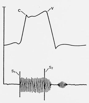 Tricuspid Valve Insufficiency Tricuspid Valve Insufficiency