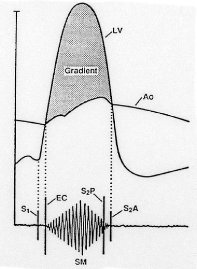 Diagram of Aortic Stenosis Diagram of Aortic Stenosis