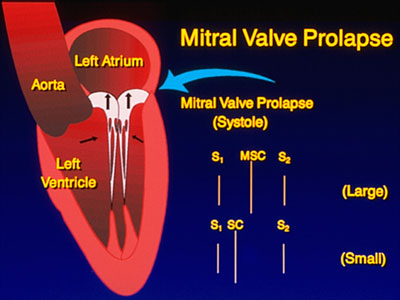 Mitral Valve Prolapse Illustration Mitral Valve Prolapse Illustration