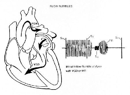 Murmur of Ventricular Septal Defect Murmur of Ventricular Septal Defect