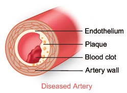 Diseased Artery Diseased Artery
