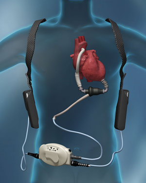 Thoratec Heartmate II VAD system Thoratec Heartmate II VAD system