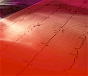Diastolic dysfunction