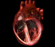 Center for Heart Valve Disease