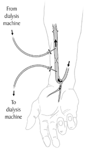Illustration of an arteriovenous fistula or A-V fistula Illustration of an arteriovenous fistula or A-V fistula