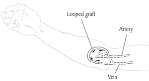 Illustration of an arteriovenous graft or A-V graft Illustration of an arteriovenous graft or A-V graft