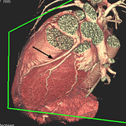 3D MDCT view shows a normal coronary artery (black arrow) and side branches. 3D MDCT view shows a normal coronary artery (black arrow) and side branches.