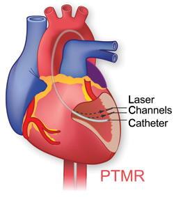 Illustration of percutaneous transmyocardial revascularization
