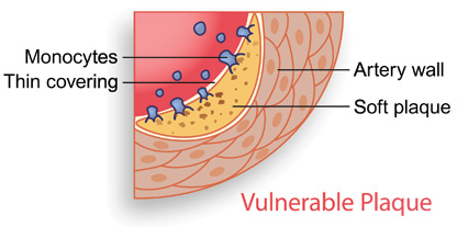 vulnerable plaque illustration