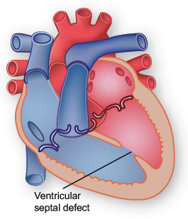 Illustration showing ventricular septal defect. Illustration showing ventricular septal defect.