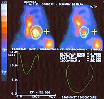 Diagnostic image from a MUGA scan.