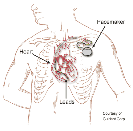 Pacemaker illustration Pacemaker illustration