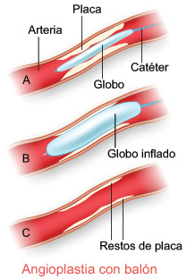 La Angioplastia con balon