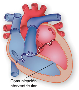Ilustración de una comunicación interventricular. Ilustración de una comunicación interventricular.