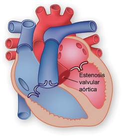 Ilustracin de una estenosis valvular artica.