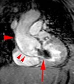 Esta IRM muestra un aneurisma de aorta y una fuga de sangre por una výlvula aýrtica defectuosa. Pulse la imagen para ver la pelýcula. Esta IRM muestra un aneurisma de aorta y una fuga de sangre por una výlvula aýrtica defectuosa. Pulse la imagen para ver la pelýcula.