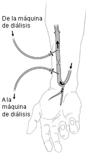 Ilustraciýn de una fýstula arteriovenosa o fýstula AV. Ilustraciýn de una fýstula arteriovenosa o fýstula AV.