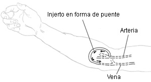 Ilustraciýn de un injerto arteriovenoso o injerto AV. Ilustraciýn de un injerto arteriovenoso o injerto AV.