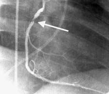 Foto de un angiograma coronario. La flecha indica una obstruccion en la arteria coronaria derecha. Foto de un angiograma coronario. La flecha indica una obstruccion en la arteria coronaria derecha.