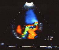 Foto de un ecocardiograma o ultrasonido Doppler. Foto de un ecocardiograma o ultrasonido Doppler.