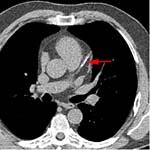TC por haz de electrones. La flecha roja indica una calcificaciýn en la arteria coronaria izquierda. TC por haz de electrones. La flecha roja indica una calcificaciýn en la arteria coronaria izquierda.