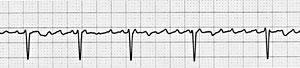 Foto de un trazado electrocardiogrýfico. Foto de un trazado electrocardiogrýfico.