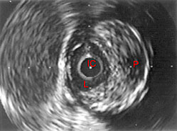 Imagen por ultrasonido intravascular que muestra el interior de una arteria coronaria. Imagen por ultrasonido intravascular que muestra el interior de una arteria coronaria.