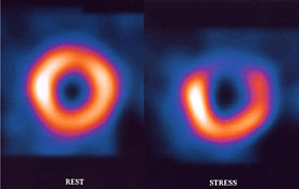 Imýgenes tomadas con el paciente en reposo y haciendo ejercicio durante una prueba de esfuerzo con isýtopos. La zona oscura indica un lugar donde el flujo de sangre es anormal. Imýgenes tomadas con el paciente en reposo y haciendo ejercicio durante una prueba de esfuerzo con isýtopos. La zona oscura indica un lugar donde el flujo de sangre es anormal.