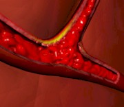 Enfermedad arterial coronaria