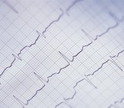 Bundle Branch Block