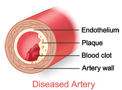 Illustration of a diseased artery