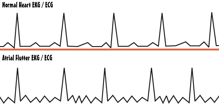 Atrial Flutter EKG