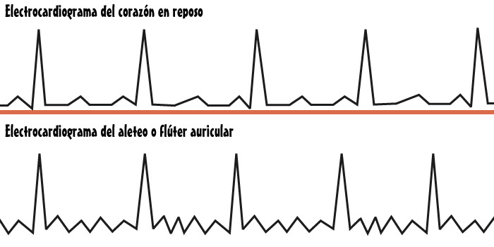 Electrocardiograma del aleteo o flúter auricular