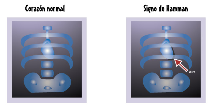 Signo de Hamman Signo de Hamman