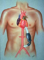Diagram of the Model-7 Abdominal Left Ventricular Assist Device (ALVAD)
