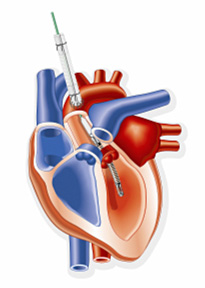 The Impella Recover LD 5.0 showing implantation via direct placement into the left ventricle.