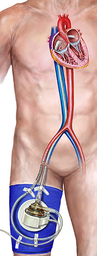Illustration of the TandemHeart pVAD. Illustration of the TandemHeart pVAD.