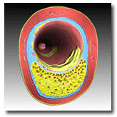 Illustration of a vulnerable plaque