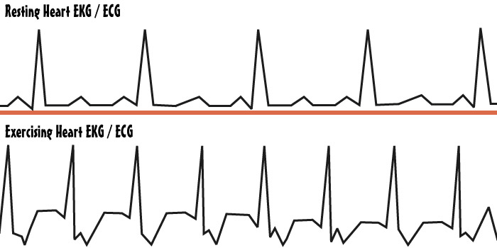Exercising Heart EKG